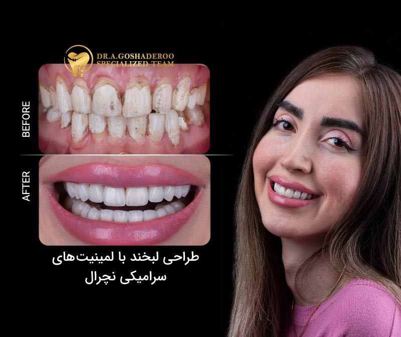 طراحی لبخند با لمینیت های سرامیکی نچرال